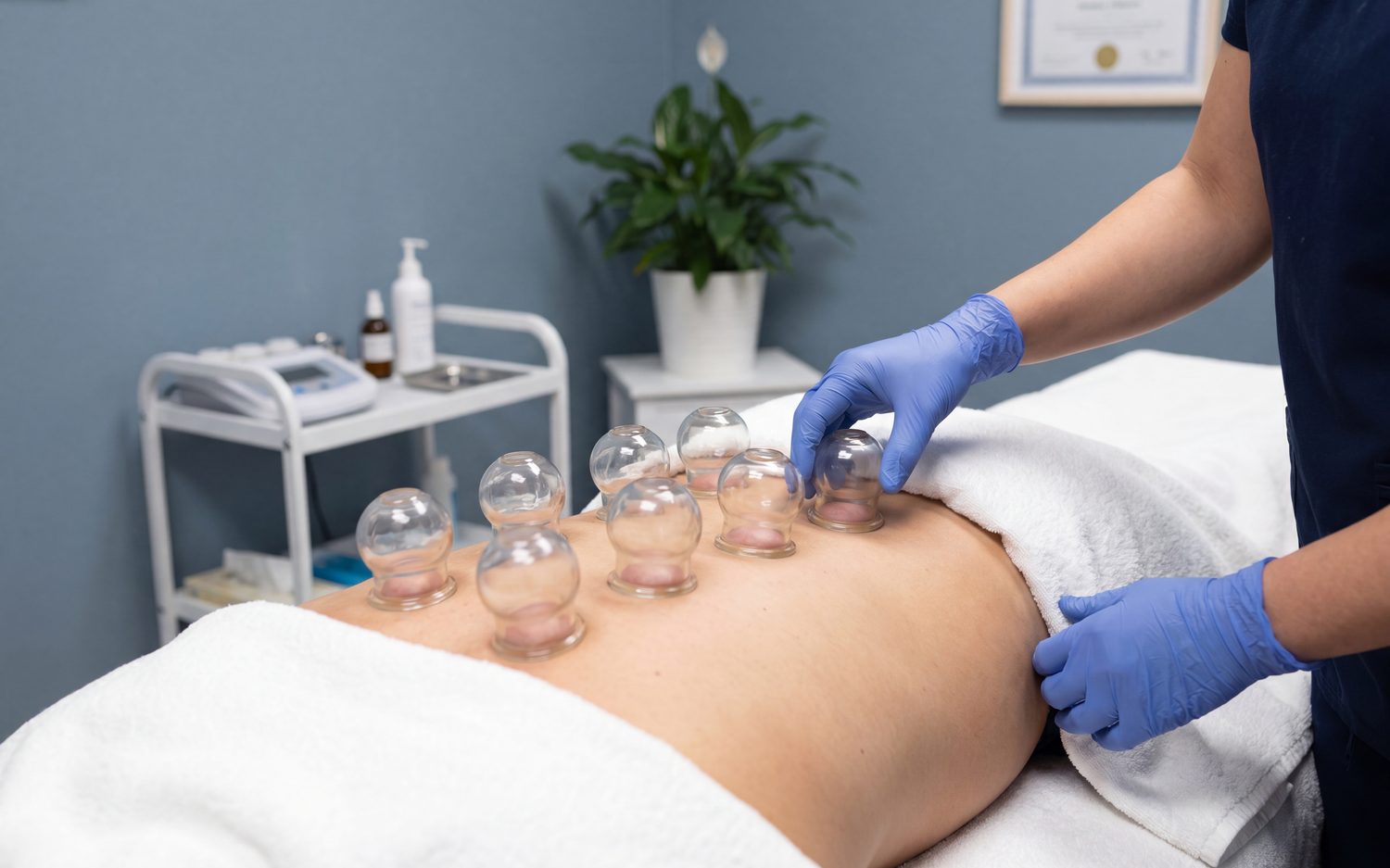 Hijama cupping therapy